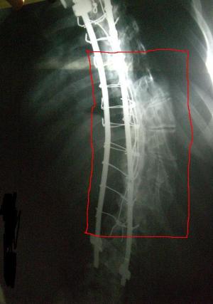 rotated-spine-column